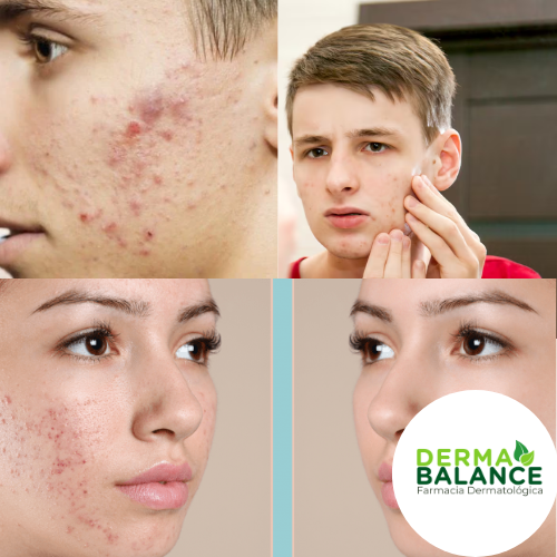 Piel grasa y acne