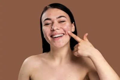 acne5
