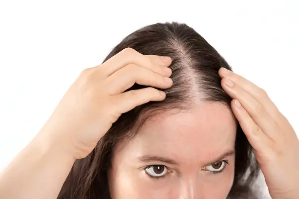 caida del cabello