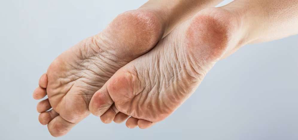 Piel deshidratada y agrietada