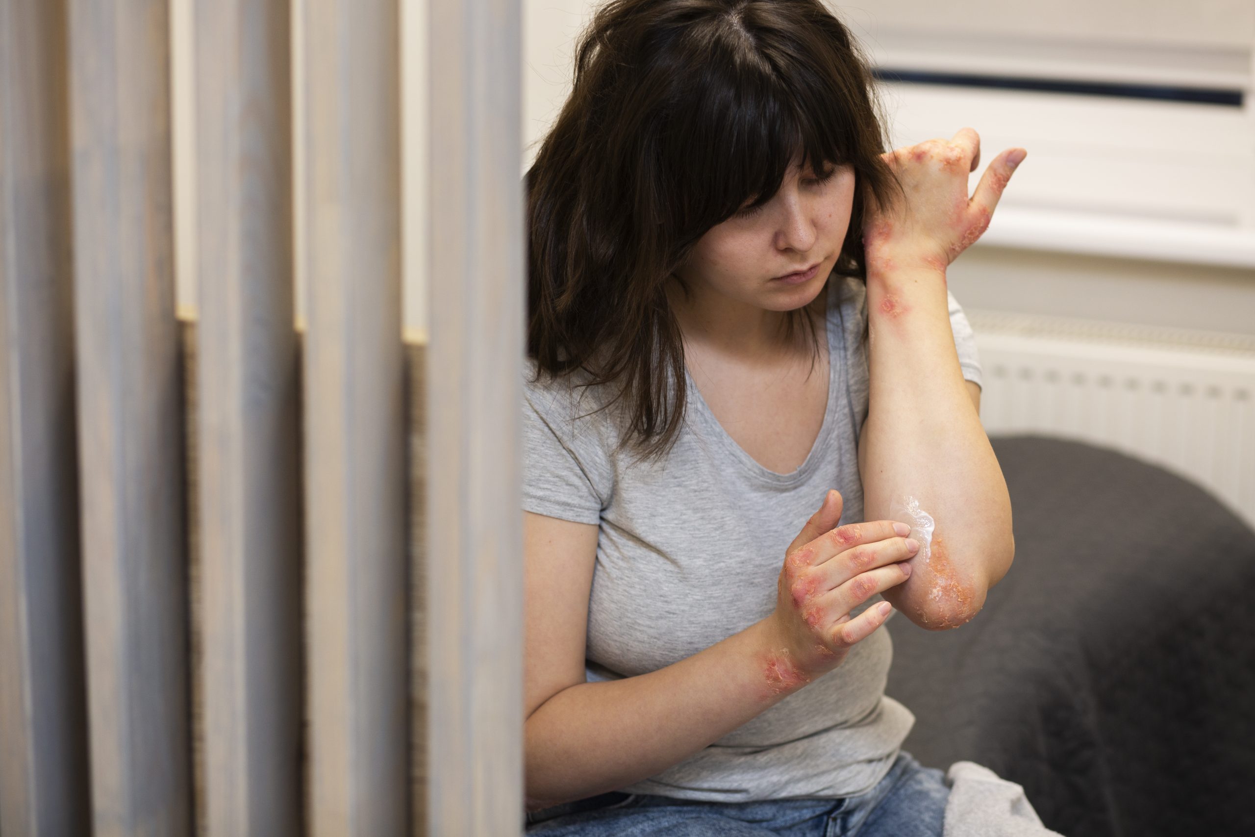 piel con psoriasis