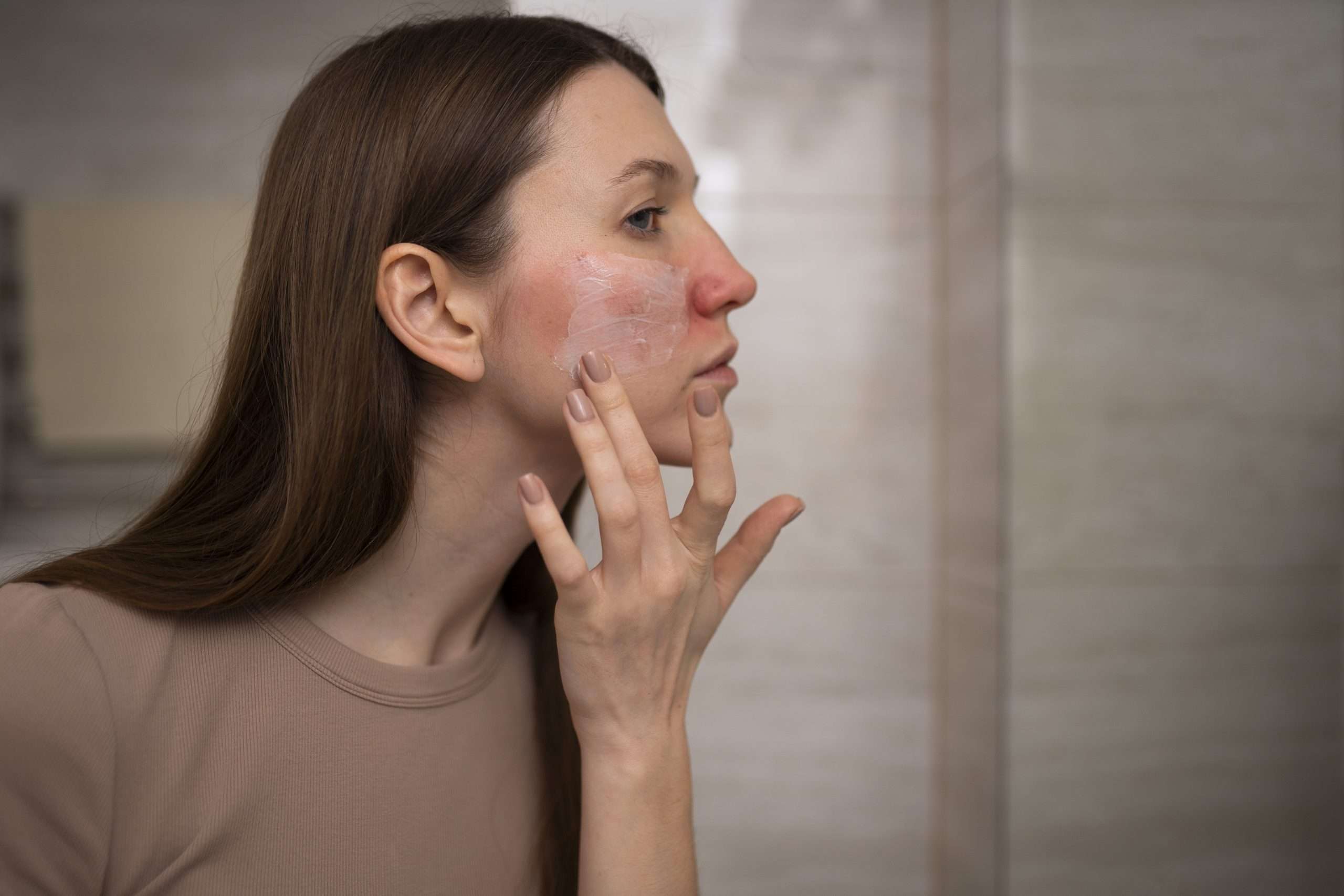 piel con psoriasis