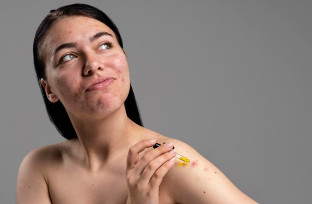 productos dermatologicos para el acne