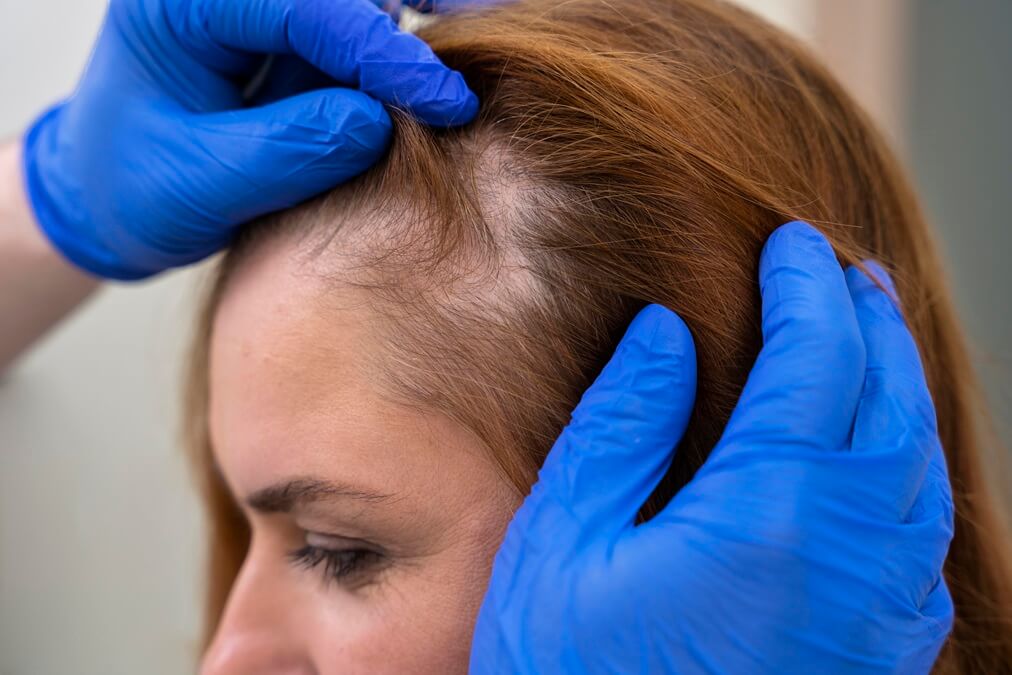 Tratamiento para caida del cabello