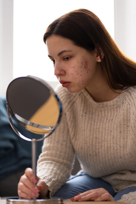 person dealing with rosacea 1