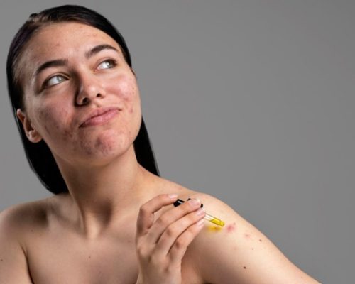 productos dermatológicos para el acné